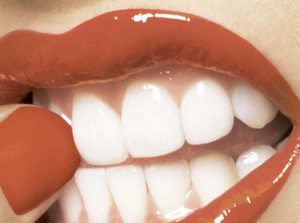 sbiancamento-dei-denti