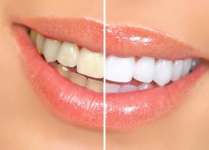sbiancamento denti