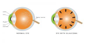 glaucoma