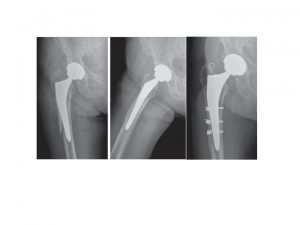 protesi-mini-invasive