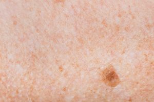 macchioline-scuresulle-gambe